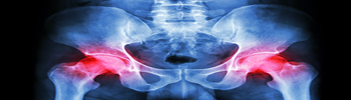 Depuy Pinnacle Hip Replacement Failure Law Firm in Cleveland Ohio